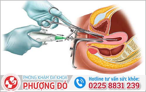 Hút thai 6 tuần tuổi