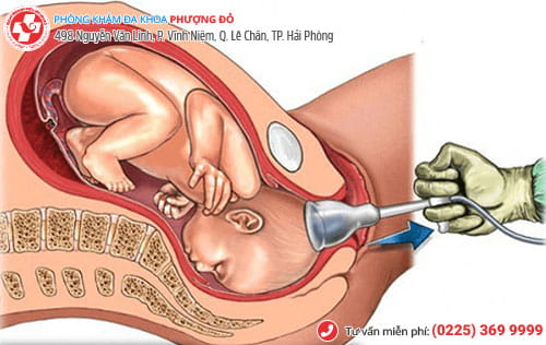 phá thai nhiều lần